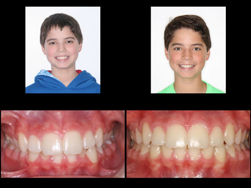 overbite before and after