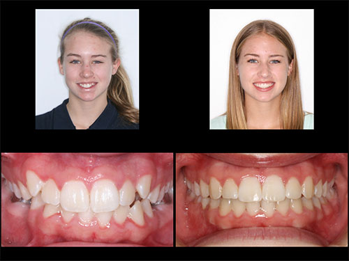 overbite before and after